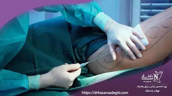 دانستنیهای قبل انجام عمل لیپوساکشن